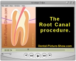 Video series: The root canal procedure.